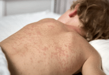 Podkarpacie: 11 przypadków odry. Poznaj kluczowe objawy tej choroby Odra wysypka