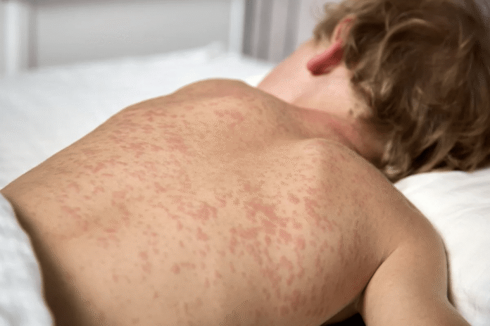 odra-choroba-zakazna Odra wysypka