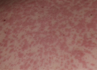 Coraz więcej przypadków odry na Podkarpaciu. Obecnie to już 23 osoby w trzech powiatach odra-podkarpacie