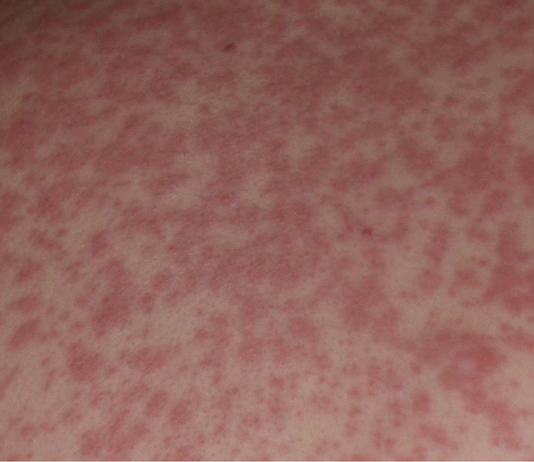 Coraz więcej przypadków odry na Podkarpaciu. Obecnie to już 23 osoby w trzech powiatach odra-podkarpacie